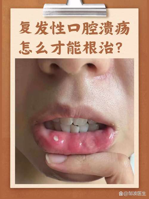 吃皮蛋口腔黏膜灼伤,吃皮蛋口腔黏膜灼伤怎么办